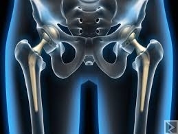 Main image of Traitement par prothèse de lâ€™arthrose de la hanche