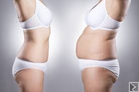 Main image of Sleeve ou gastroplastie verticale