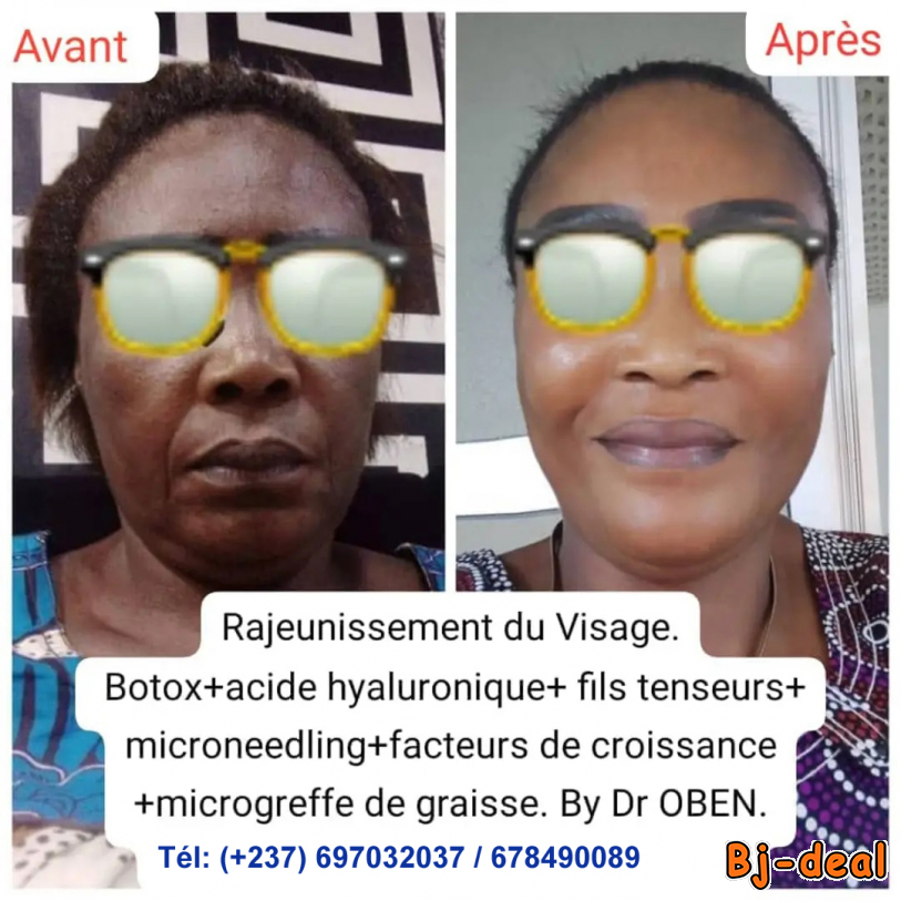Image principale de Rajeunissement du visage microgreffe de graisse