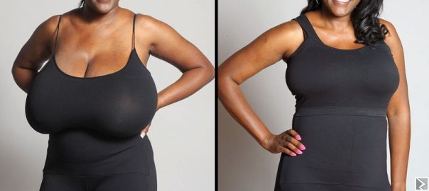 Main image of RÉDUCTION MAMMAIRE