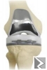 Image principale de Prothèse de lâ€™arthrose du genou