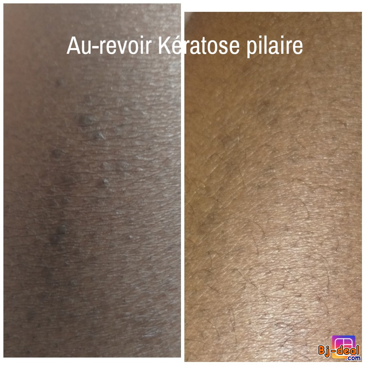 Image principale de Au-revoir Kératose pilaire