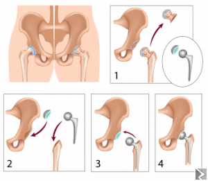 Image principale de Prothèse de lâ€™arthrose de la hanche