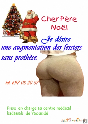 Image principale de augmentation des fessiers sans prothèse