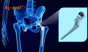 Image principale de Souffrez-vous d arthrose de la hanche