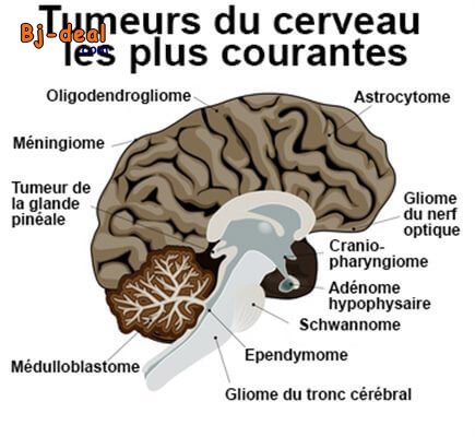 Image principale de Vous souffrez d une Tumeur au Cerveau