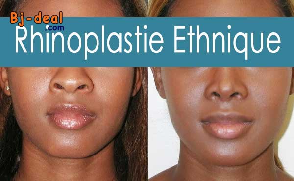 Image principale de Rhinoplastie à Yaoundé