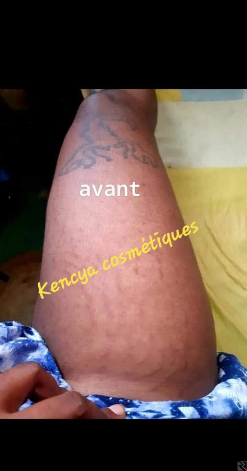 Main image of Produit des vergetures