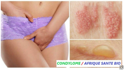 Image principale de Remedio  natural fibromas miomas