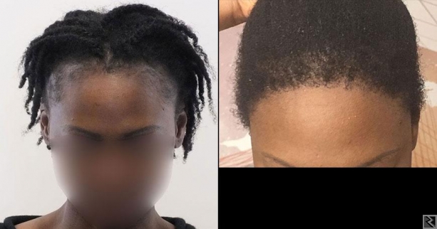 Image principale de Greffe de cheveux au Cameroun