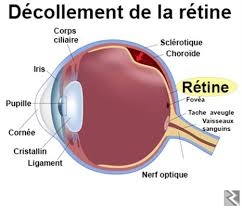 Main image of traitement décollement de la rétine