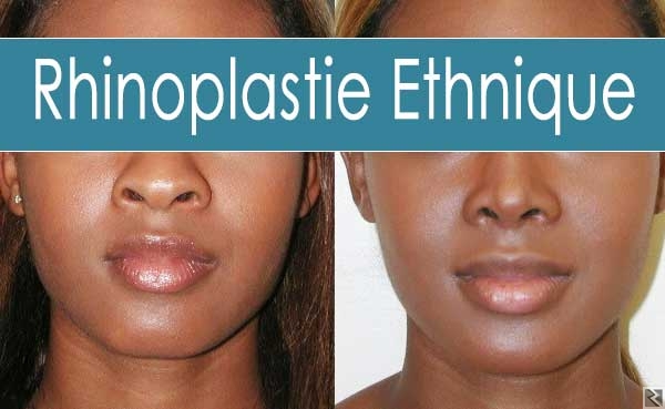 Image principale de RHINOPLASTIE
