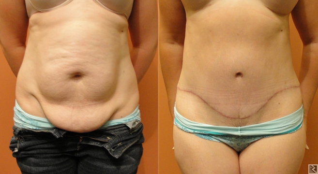 Main image of Abdominoplastie
