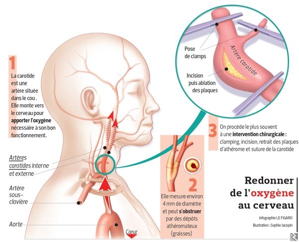 Main image of Operation anévrisme
