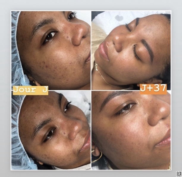 Image principale de PEELING DU VISAGE