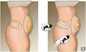 Image principale de Amincissement Médical  Lipolyse et Lipodissolutio