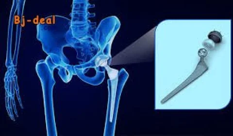 Image principale — Souffrez-vous d arthrose de la hanche