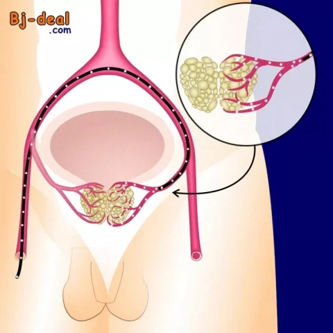 Image principale — Embolisation de la Prostate en Afrique Libérez-vous de l Adénome