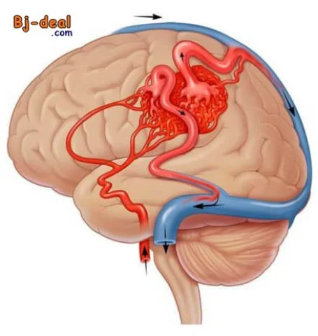 Main image — Les malformations vasculaires cérébrales C est quoi